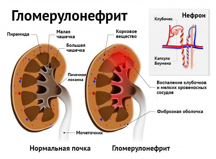 сбор мочи по зимницкому